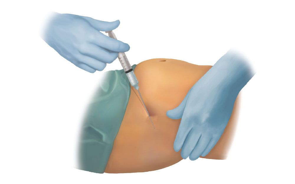 anestesia-trattamento-lipogems